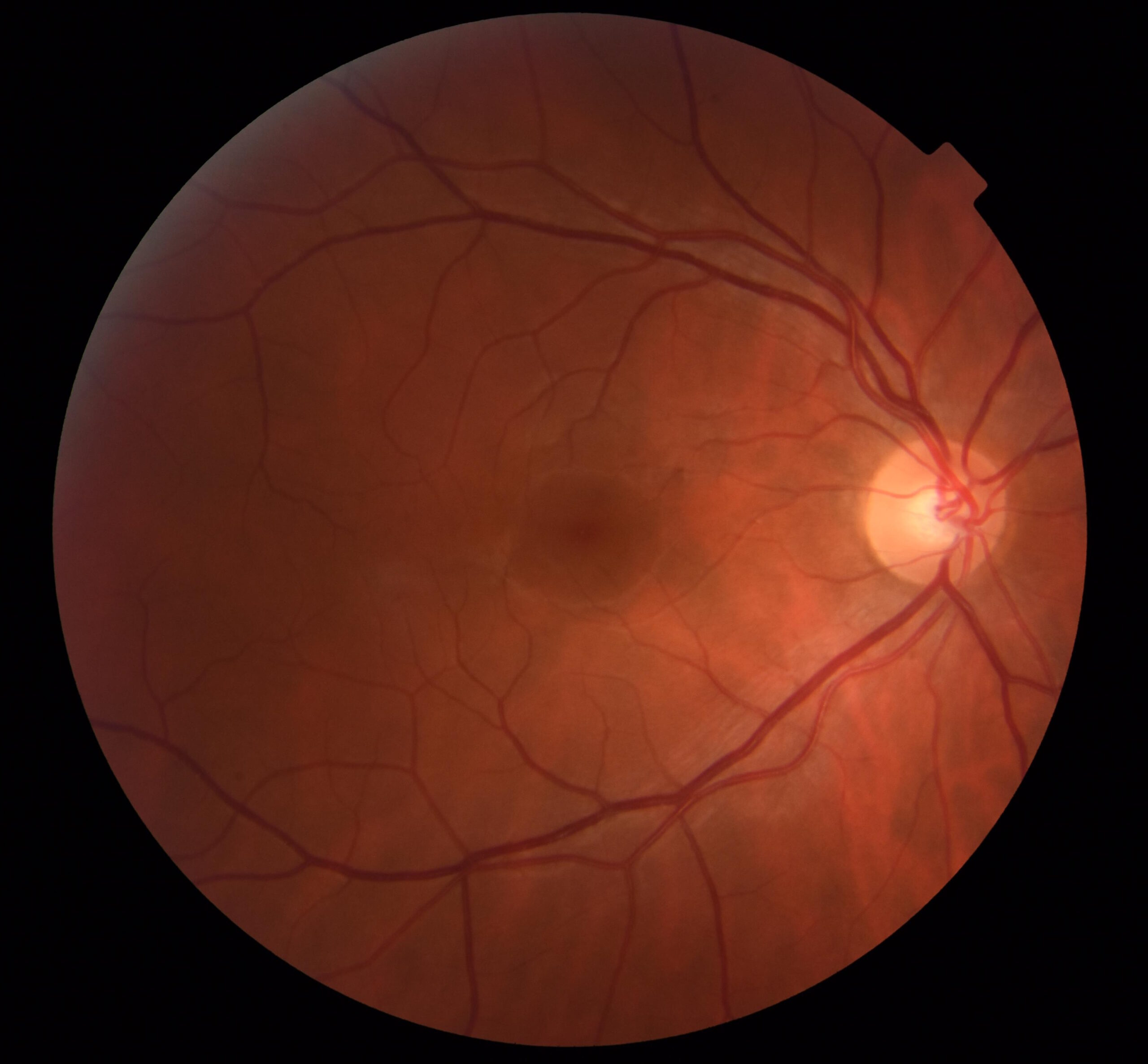 Overcoming Retinal Diseases: Can the Retina Heal Itself